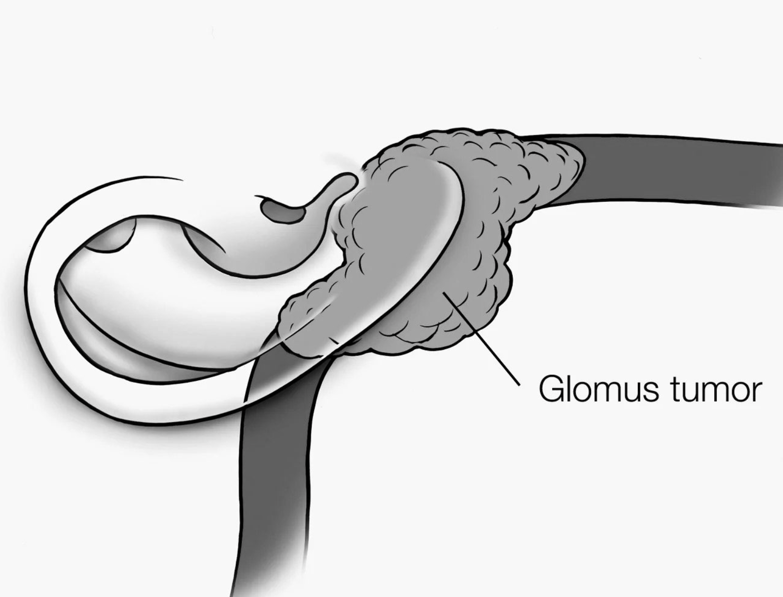 Temporal Bone Paraganglioma